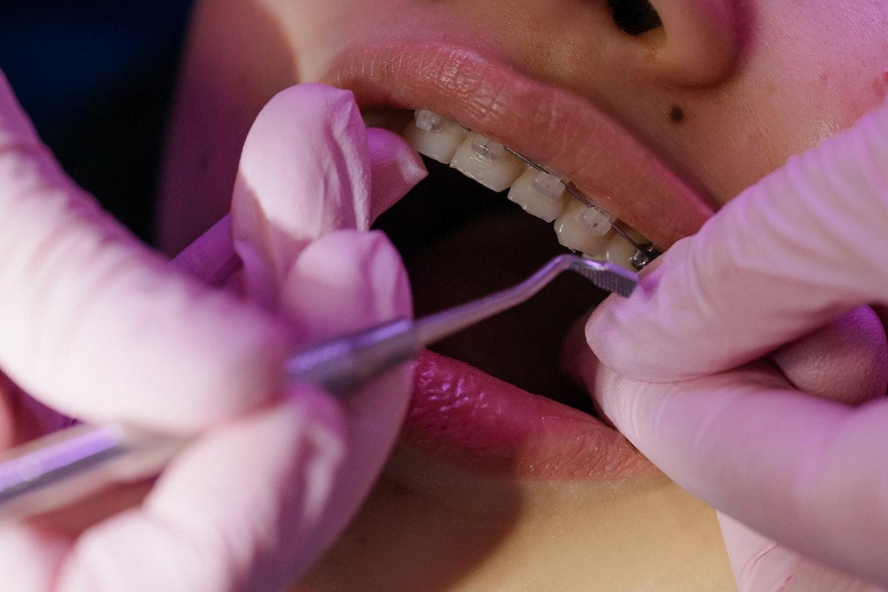 Brackets autoligados