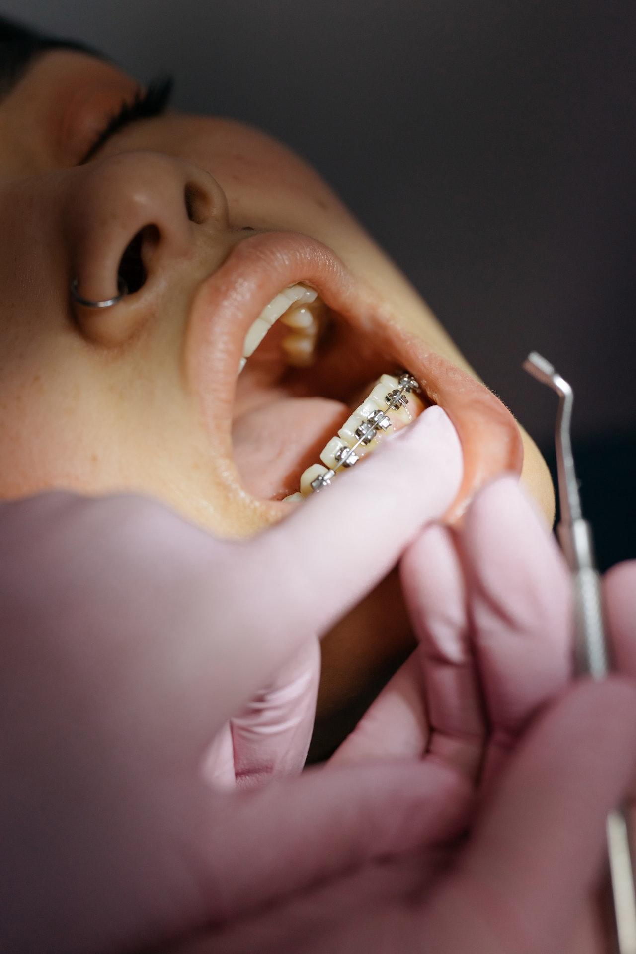 Brackets autoligados