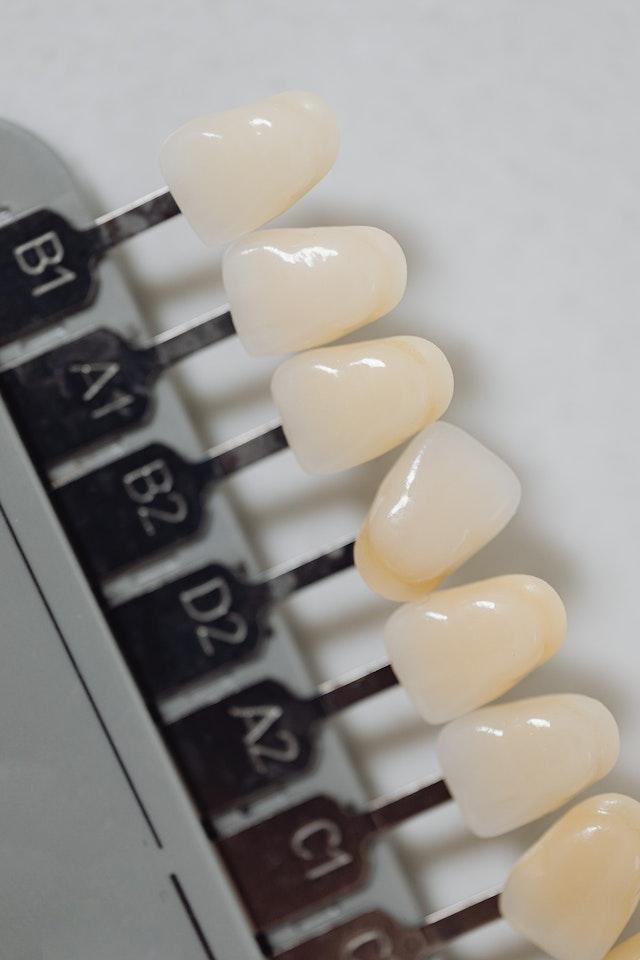 Carillas dentales